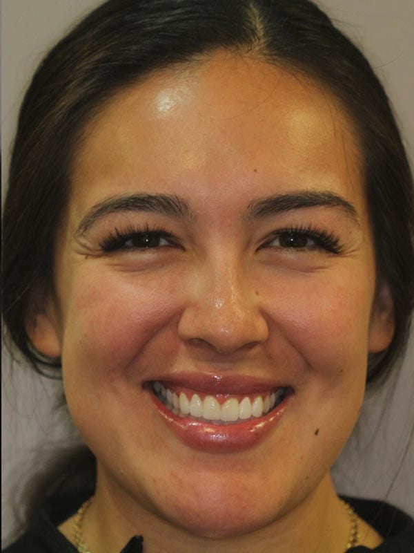 OC Healthy Smiles - After Veneers 02