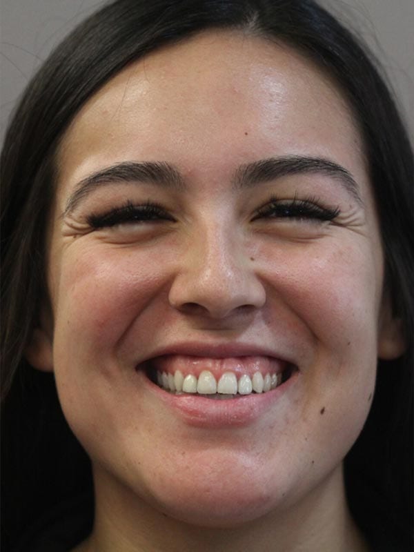 OC Healthy Smiles - Before Veneers 02
